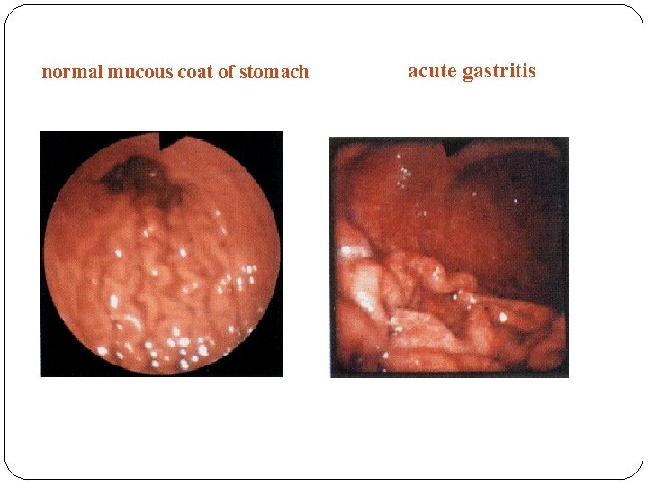 normal mucous coat of stomach acute gastritis normal mucous coat of stomach acute gastritis
