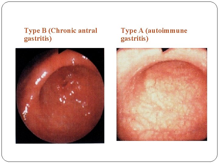 Type B (Chronic antral gastritis) Type A (autoimmune gastritis) Type B (Chronic antral gastritis) Type A (autoimmune gastritis)