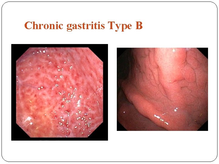 Chronic gastritis Type B 