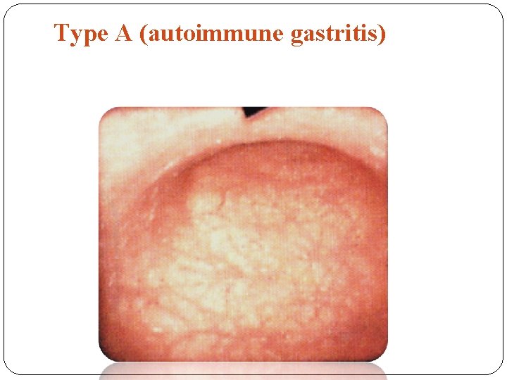 Type A (autoimmune gastritis) 