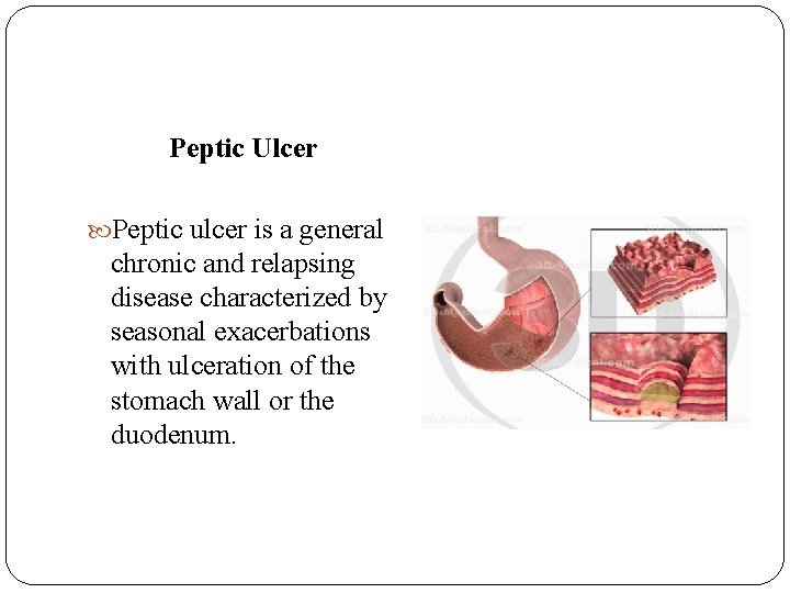 Peptic Ulcer Peptic ulcer is a general chronic and relapsing disease characterized by seasonal