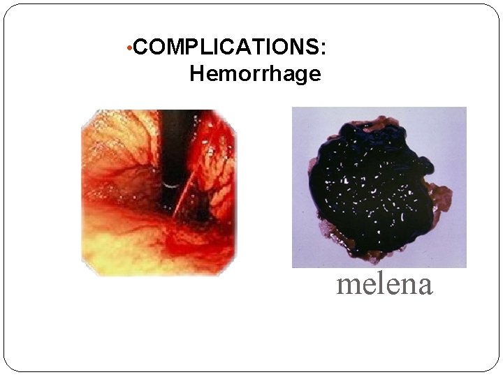  • COMPLICATIONS: Hemorrhage melena 