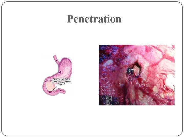 Penetration Penetration
