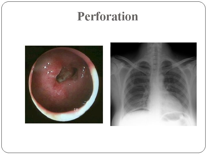 Perforation Perforation