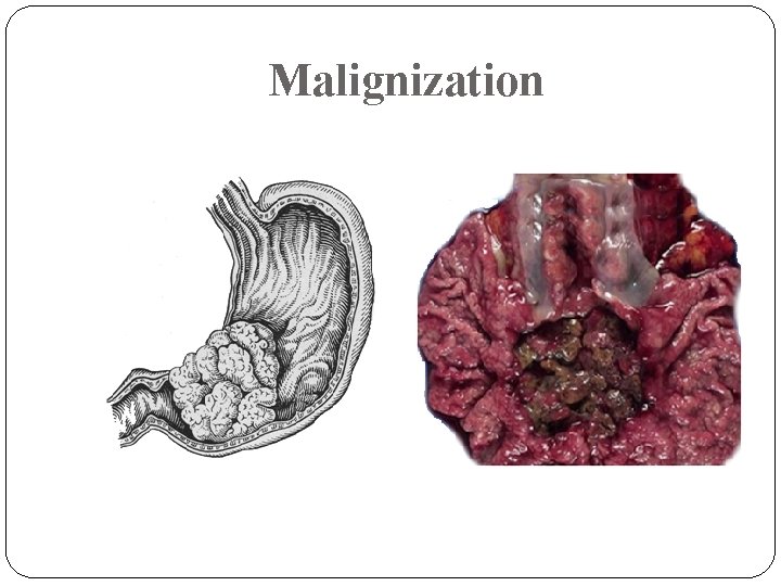 Malignization 