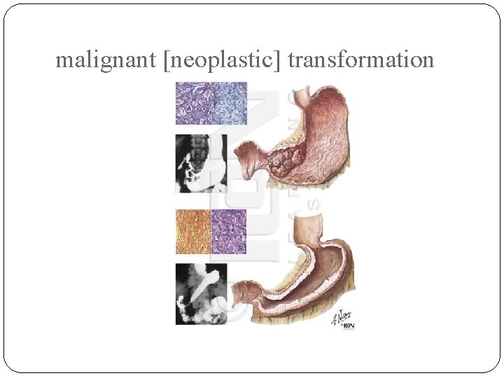 malignant [neoplastic] transformation 