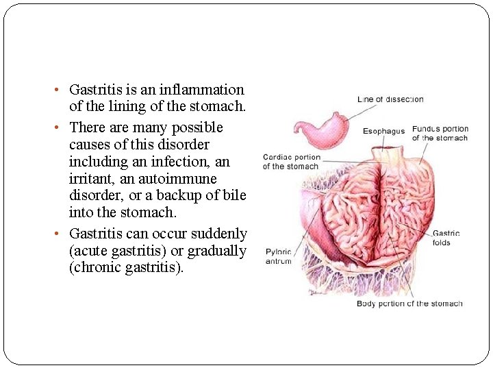  • Gastritis is an inflammation of the lining of the stomach. • There