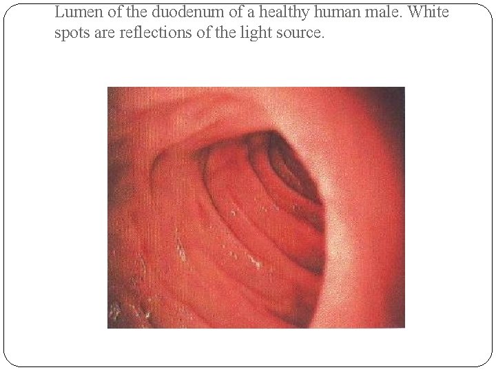 Lumen of the duodenum of a healthy human male. White spots are reflections of