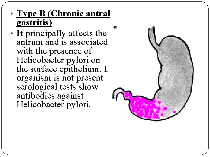  • Type B (Chronic antral gastritis) • It principally affects the antrum and
