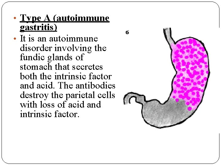 • Type A (autoimmune gastritis) • It is an autoimmune disorder involving the • Type A (autoimmune gastritis) • It is an autoimmune disorder involving the