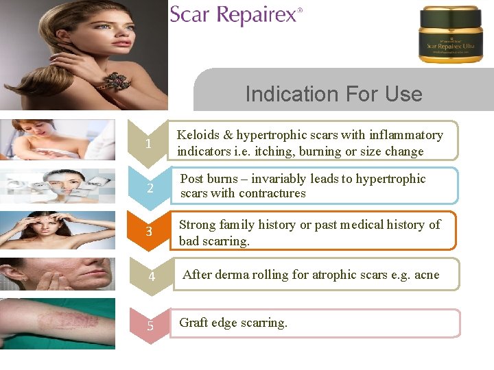 Indication For Use 1 Keloids & hypertrophic scars with inflammatory indicators i. e. itching,