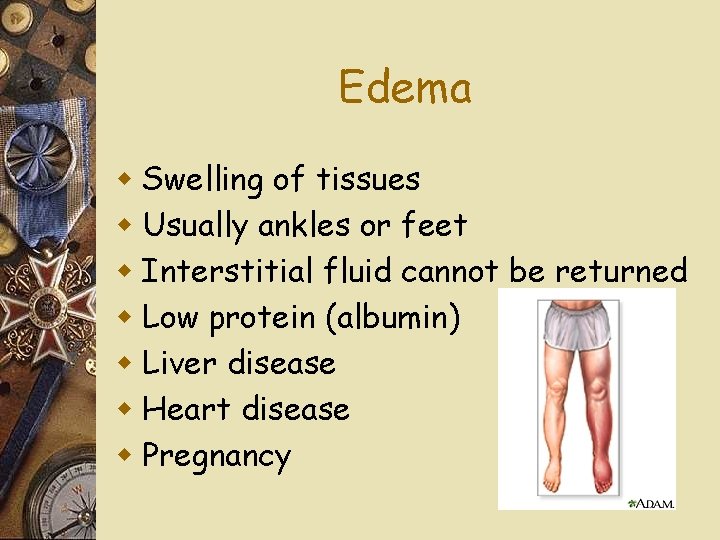 Edema w Swelling of tissues w Usually ankles or feet w Interstitial fluid cannot