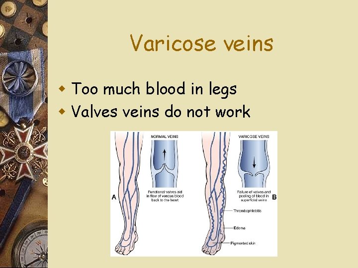 Varicose veins w Too much blood in legs w Valves veins do not work