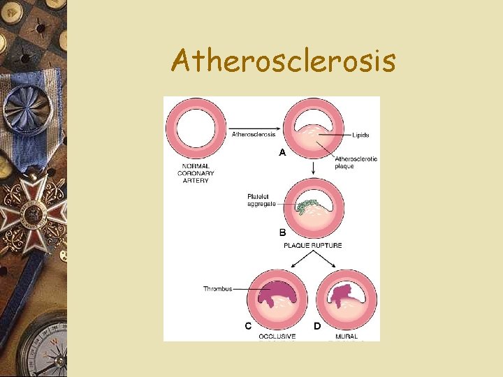 Atherosclerosis 