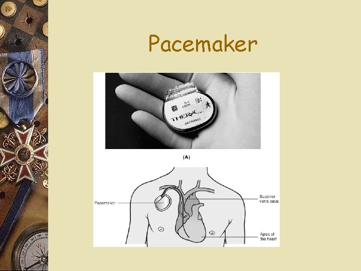 Pacemaker 