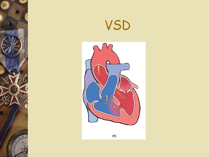 VSD 