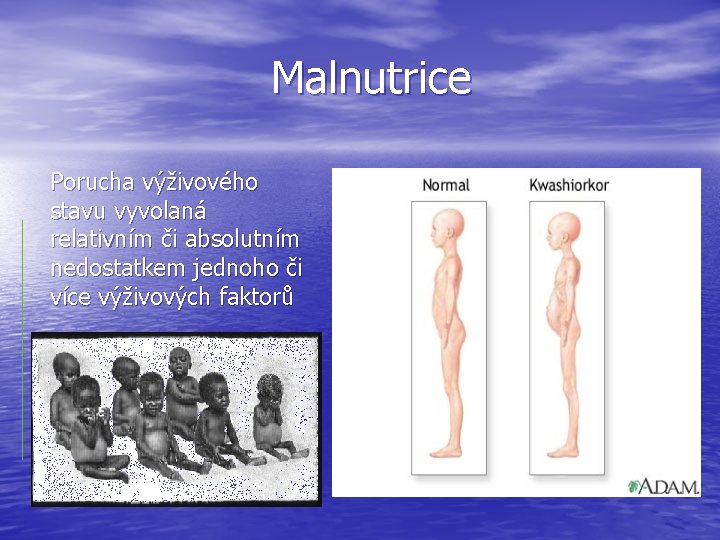 Malnutrice Porucha výživového stavu vyvolaná relativním či absolutním nedostatkem jednoho či více výživových faktorů