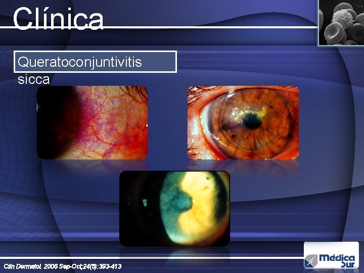 Clínica Queratoconjuntivitis sicca Clin Dermatol. 2006 Sep-Oct; 24(5): 393 -413 