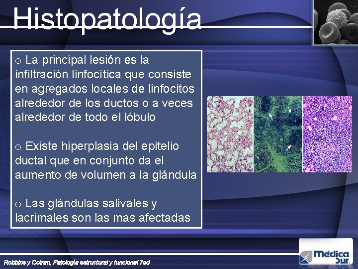 Histopatología o La principal lesión es la infiltración linfocítica que consiste en agregados locales