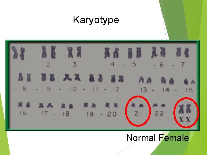 Karyotype Normal Female 