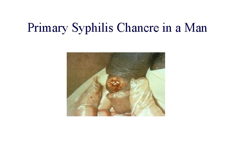 STD 101 for Non-Clinicians Primary Syphilis Chancre in a Man Source: CDC/ NCHSTP/ Division