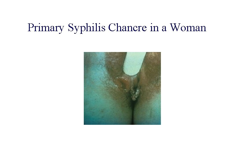 STD 101 for Non-Clinicians Primary Syphilis Chancre in a Woman Source: CDC/ NCHSTP/ Division