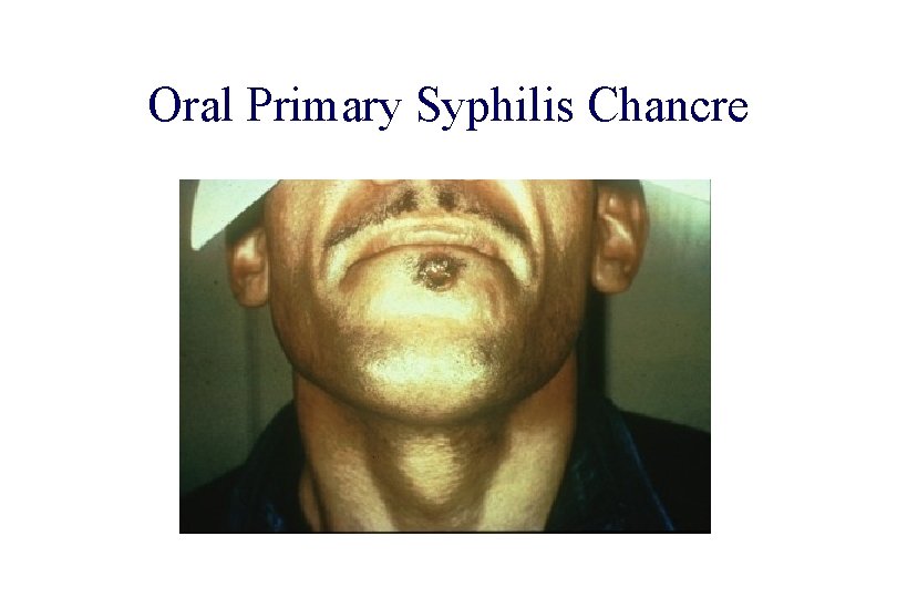 STD 101 for Non-Clinicians Oral Primary Syphilis Chancre Source: CDC/ NCHSTP/ Division of STD