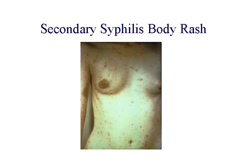 STD 101 for Non-Clinicians Secondary Syphilis Body Rash Source: CDC/ NCHSTP/ Division of STD