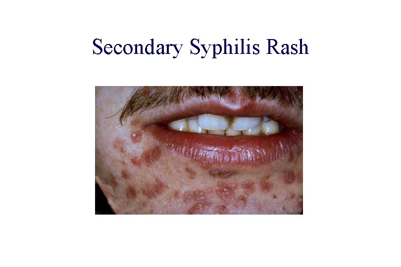 STD 101 for Non-Clinicians Secondary Syphilis Rash Source: Cincinnati STD/HIV Prevention Training Center Syphilis