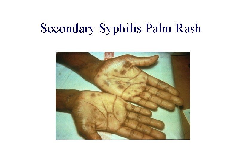 STD 101 for Non-Clinicians Secondary Syphilis Palm Rash Source: CDC/ NCHSTP/ Division of STD