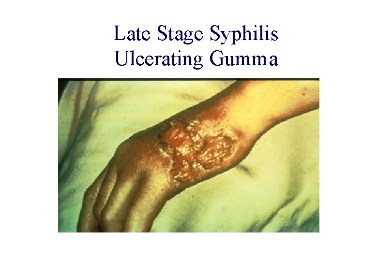 STD 101 for Non-Clinicians Syphilis Late Stage Syphilis Ulcerating Gumma Source: CDC/ NCHSTP/ Division