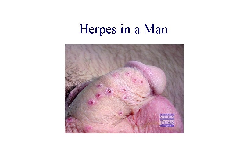 STD 101 for Non-Clinicians Herpes in a Man Source: Cincinnati STD/HIV Prevention Training Center