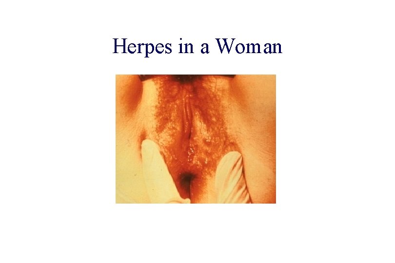 STD 101 for Non-Clinicians Herpes in a Woman Source: CDC/NCHSTP/Division of STD, STD Clinical