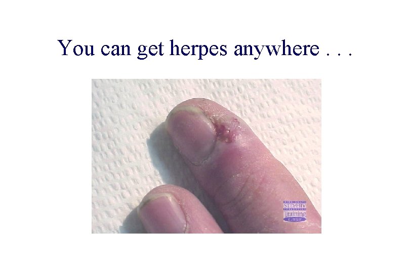 STD 101 for Non-Clinicians You can get herpes anywhere. . . Source: Cincinnati STD/HIV