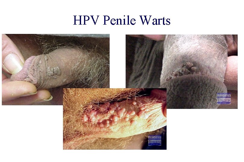 STD 101 for Non-Clinicians HPV Penile Warts Source: Cincinnati STD/HIV Prevention Training Center 