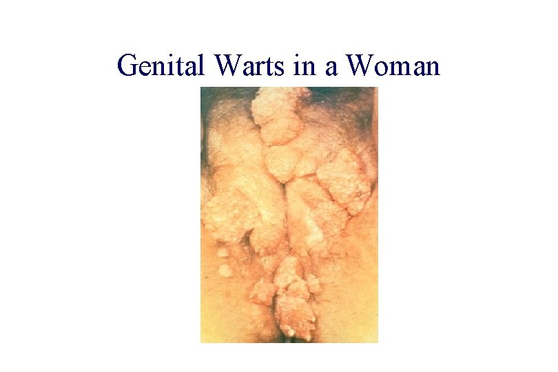STD 101 for Non-Clinicians Genital Warts in a Woman Source: CDC/NCHSTP/Division of STD, STD