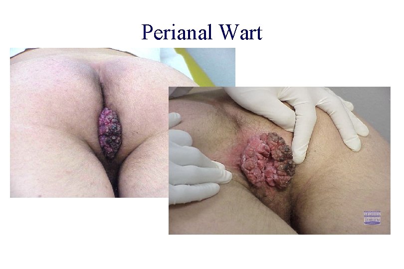 STD 101 for Non-Clinicians HPV Perianal Wart Source: Cincinnati STD/HIV Prevention Training Center 