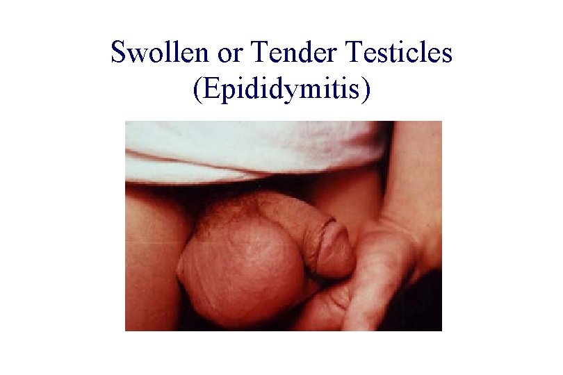 STD 101 for Non-Clinicians Swollen or Tender Testicles (Epididymitis) Source: Health Awareness Connection, http: