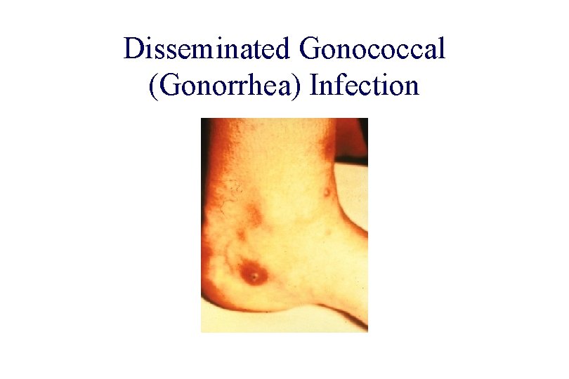 STD 101 for Non-Clinicians Disseminated Gonococcal (Gonorrhea) Infection Source: CDC/NCHSTP/Division of STD Prevention, STD STD 101 for Non-Clinicians Disseminated Gonococcal (Gonorrhea) Infection Source: CDC/NCHSTP/Division of STD Prevention, STD