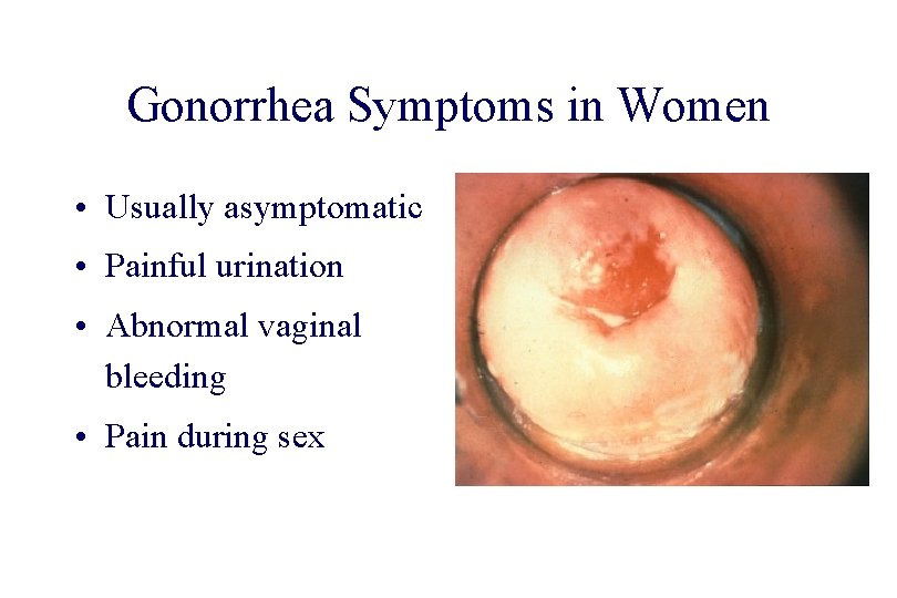 STD 101 for Non-Clinicians Gonorrhea Symptoms in Women • Usually asymptomatic • Painful urination