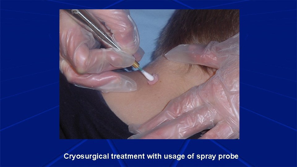 Cryosurgical treatment with usage of spray probe 