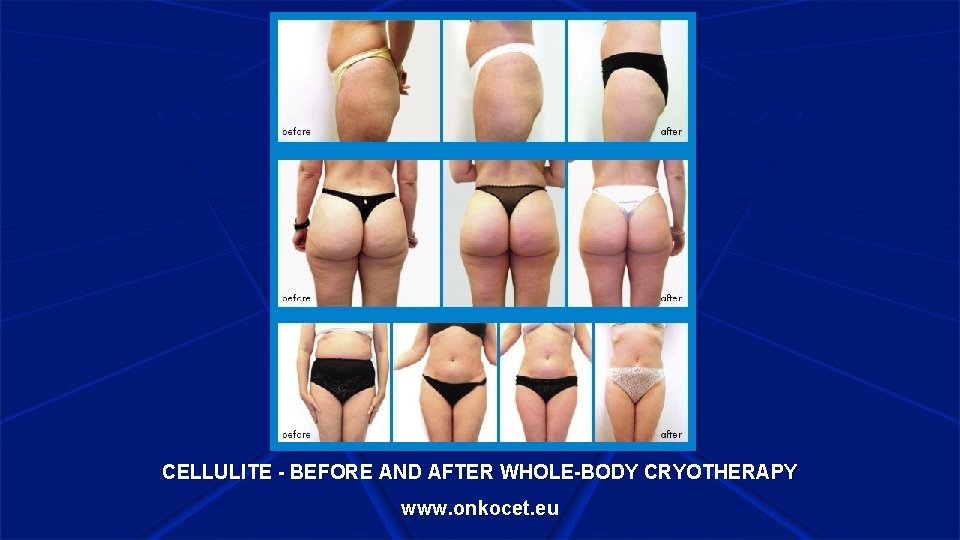 CELLULITE - BEFORE AND AFTER WHOLE-BODY CRYOTHERAPY www. onkocet. eu 