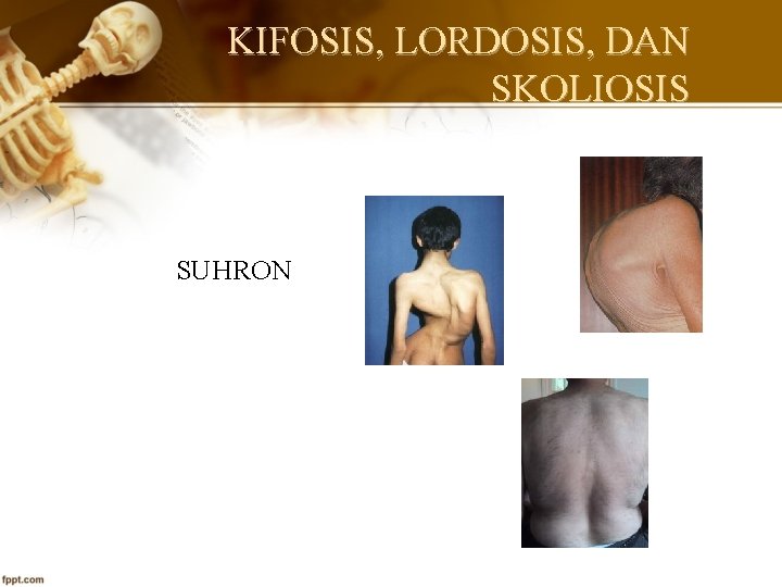 KIFOSIS, LORDOSIS, DAN SKOLIOSIS SUHRON 