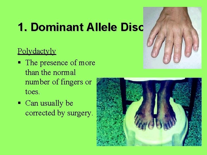 1. Dominant Allele Disorders Polydactyly § The presence of more than the normal number