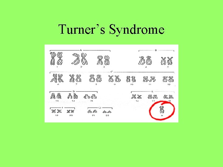 Turner’s Syndrome 