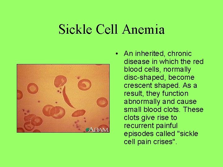 Sickle Cell Anemia • An inherited, chronic disease in which the red blood cells,