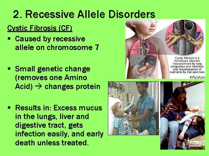 2. Recessive Allele Disorders Cystic Fibrosis (CF) § Caused by recessive allele on chromosome
