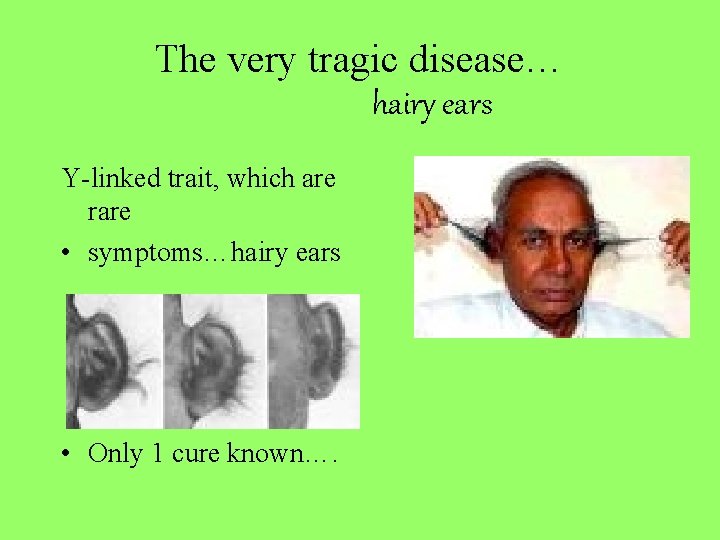The very tragic disease… hairy ears Y-linked trait, which are rare • symptoms…hairy ears