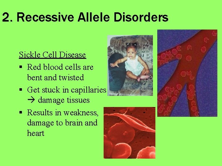 2. Recessive Allele Disorders Sickle Cell Disease § Red blood cells are bent and