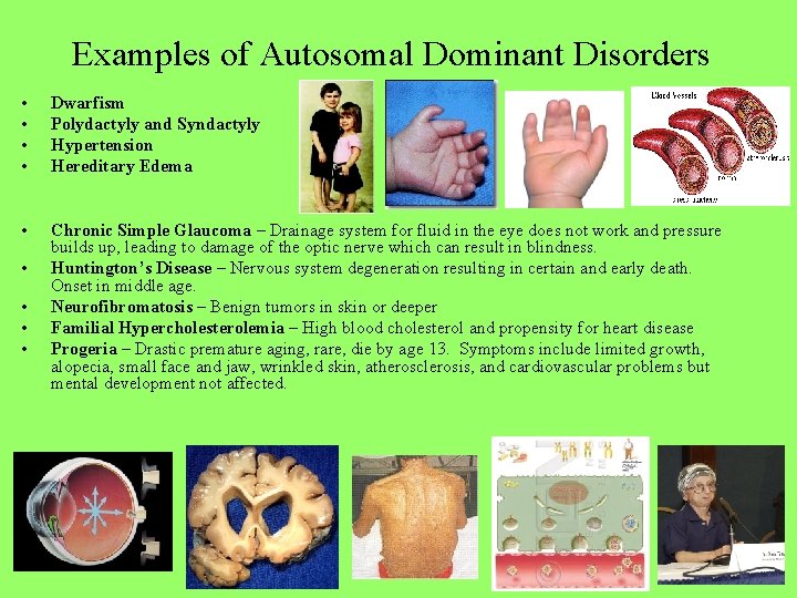 Examples of Autosomal Dominant Disorders • • Dwarfism Polydactyly and Syndactyly Hypertension Hereditary Edema
